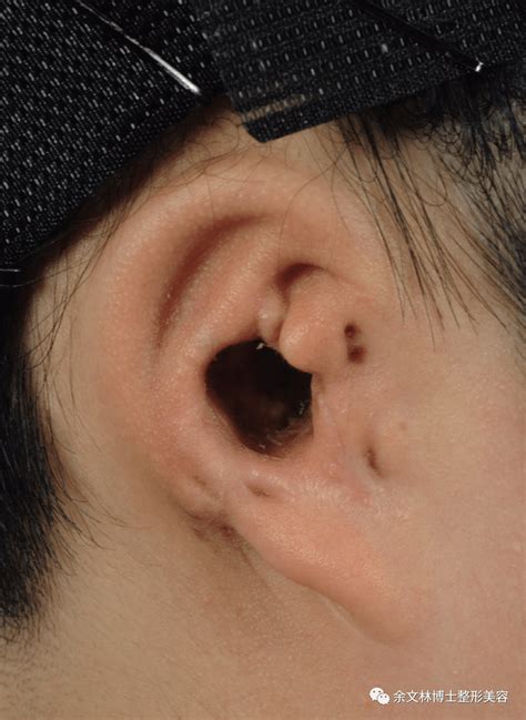 耳垂耳洞 引藻直銷